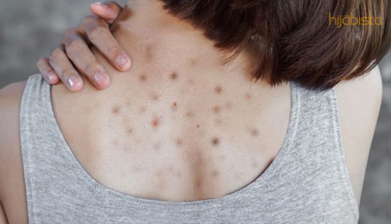 Pakai Pakaian Longgar Boleh Elak Jerawat Pasir Di Badan. Ini 8 Cara Mudah Hilangkannya!