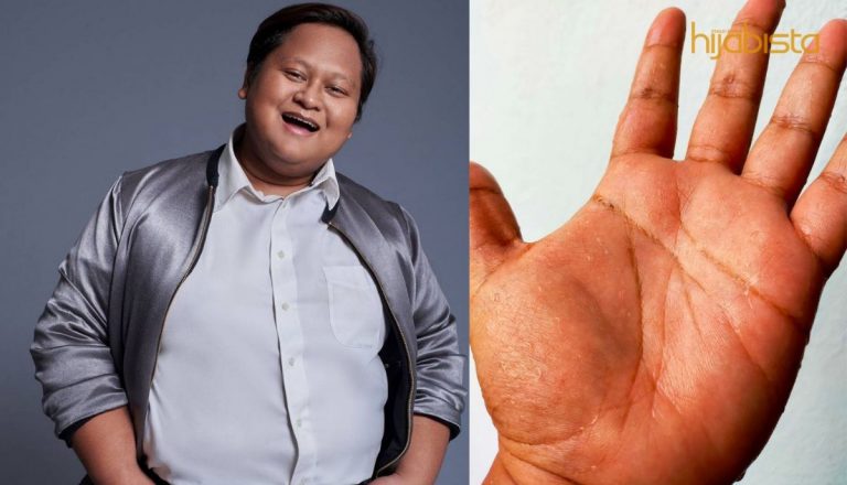 Rasa Malu & Hina Bila Peluh Secara Berlebihan, Pereka Fesyen Ini Kongsi Tentang Hiperhidrosis!