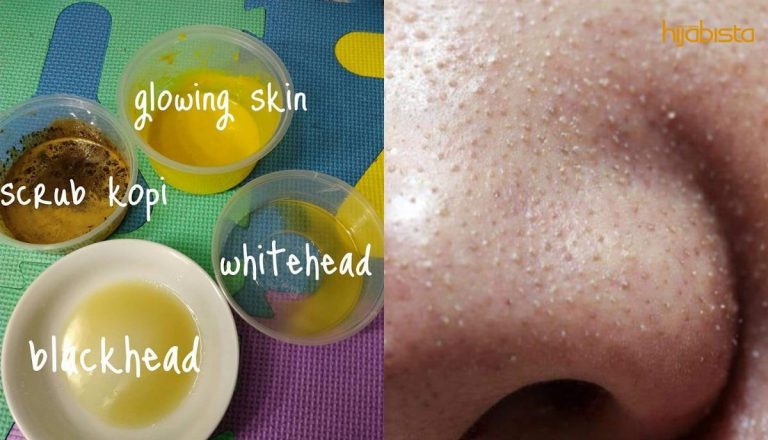 Lenyapkan Blackhead Dengan Bajet Tak Sampai RM20, Kongsi Wanita Ini