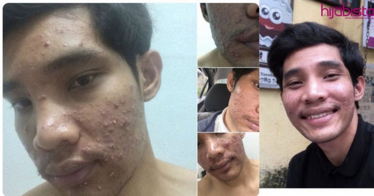 Dengan Hanya RM7, Masalah Kulit Breakout Lelaki Ini Akhirnya Pulih. Wajah Pun Bersih!