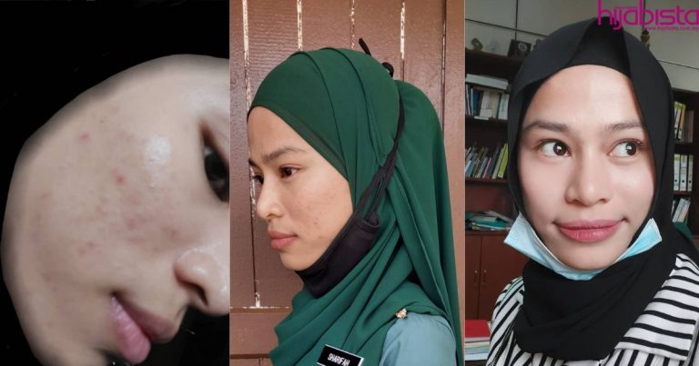 Muka Breakout Gara-Gara Ayam, Gadis Ini Kongsi Cara & Produk Terbaik Bagi Pulihkannya
