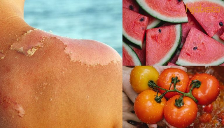 Sakitnya Bila Kulit Mengalami ‘Sunburn’! Atasinya Dengan Pilihan Bahan Semula Jadi Ini!