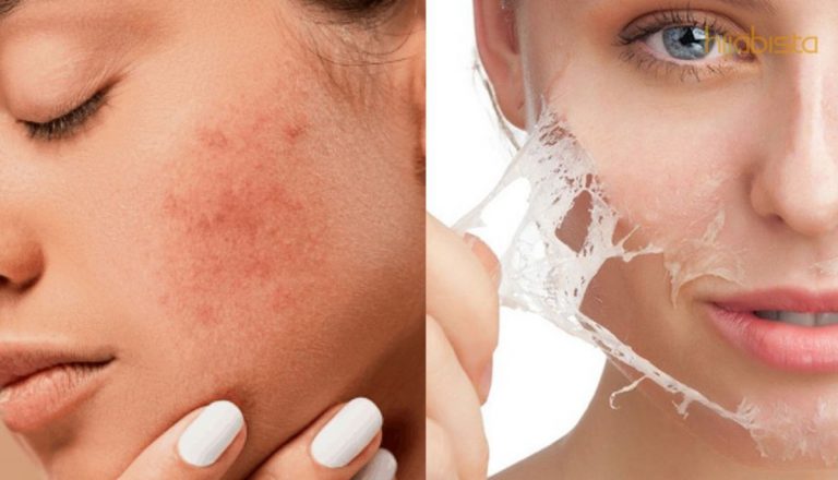 Dah Guna Banyak Produk Dan Rawatan, Kulit Masih Bermasalah?  Atasinya Dengan 6 Solusi Terbaik Ini!