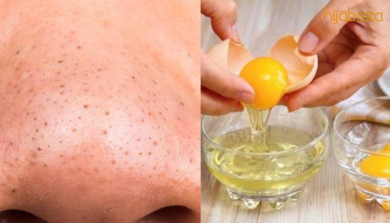 Geramnya Bila Banyak ‘Blackheads’ Di Wajah! Menggelikan! Lenyapkannya Dengan 5 Bahan Semula Jadi Ini!