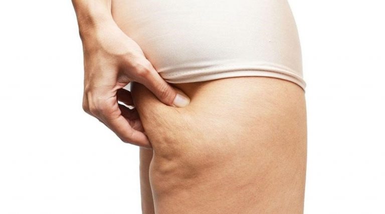 6 Senaman Mudah Hapuskan Selulit Di Paha Dan Punggung. 14 Hari Dah Nampak Hasilnya!