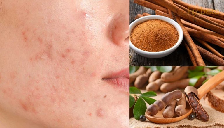 Parut Jerawat Punca Hilang Keyakinan Diri, Pudarkannya Dengan 5 Cara Semula Jadi Yang Murah Dan Mudah Ini!