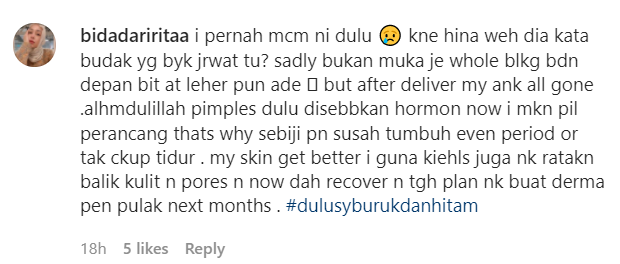 Pernah Ditolak Kerana Kulit Wajah, Sissy Imann Kongsi Peritnya Bila Alami Masalah Breakout