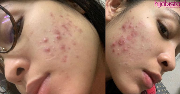 Pernah Ditolak Kerana Kulit Wajah, Sissy Imann Kongsi Peritnya Bila Alami Masalah Breakout