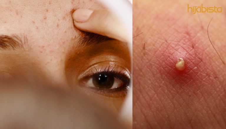 Atasi Masalah Jerawat Dengan Pemakanan! Ini 5 Jenis Makanan Yang Baik Untuk Masalah Jerawat.