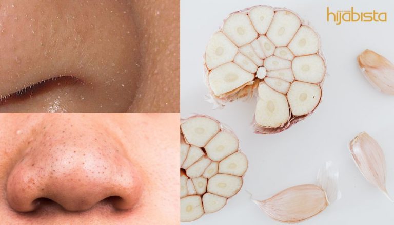 Nyahkan Whitehead Dan Blackhead, Tak Sangka Dengan Bawang Putih & Kentang. Mudah Sangat!