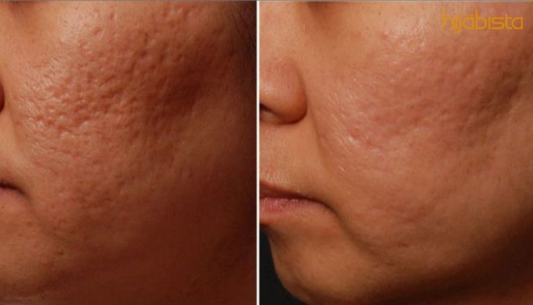 Parut Di Wajah Jejas Kecantikan, Gunakan 5 Bahan Semula Jadi Ini Untuk Hilangkan Parut.