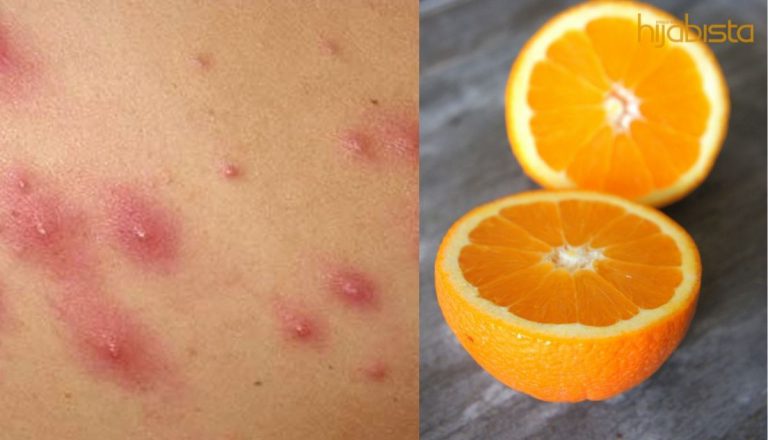 Masalah Jerawat Di Badan Punca Stres, Atasinya Dengan Pilihan Bahan Semula Jadi Ini!