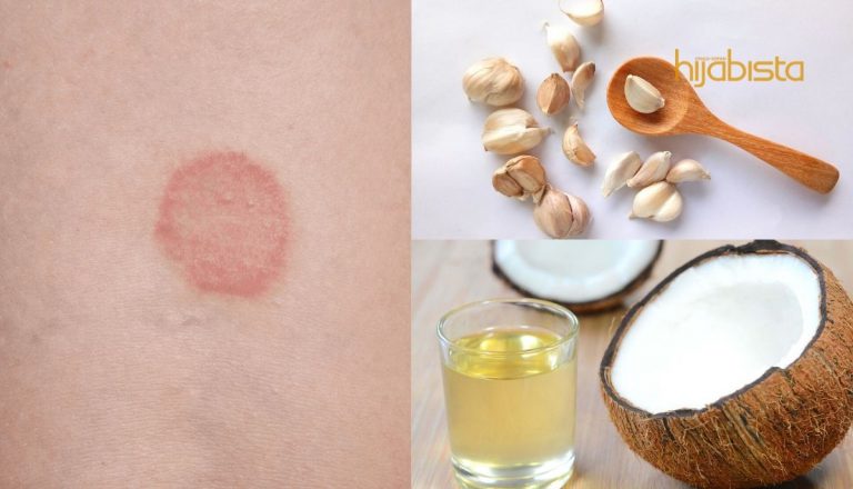 Rawat Kurap Pada Kulit Sebelum Parah, 7 Bahan Sedia Ada Di Rumah Selamatkan Keadaan