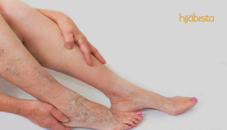 Urat Simpul Di Paha Dan Kaki,Jangan Ambil Mudah Wanita Bersaiz Gempal!