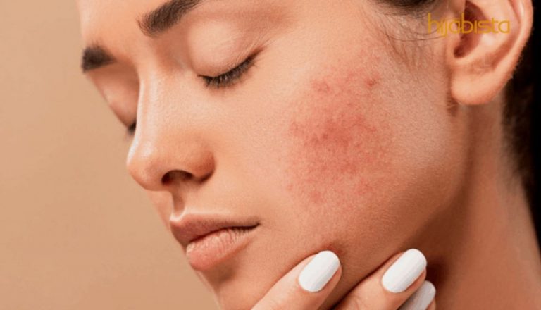 Selalu Cuci Muka Punca Jerawat Naik, Ini Antara Kesalahan Menjaga Kulit Wajah Yang Wajib Anda Tahu!