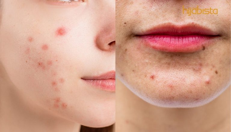 Jerawat Tumbuh Tanda Organ Tidak Sihat? Inilah Punca Jerawat Sering Muncul Di 7 Bahagian Badan!