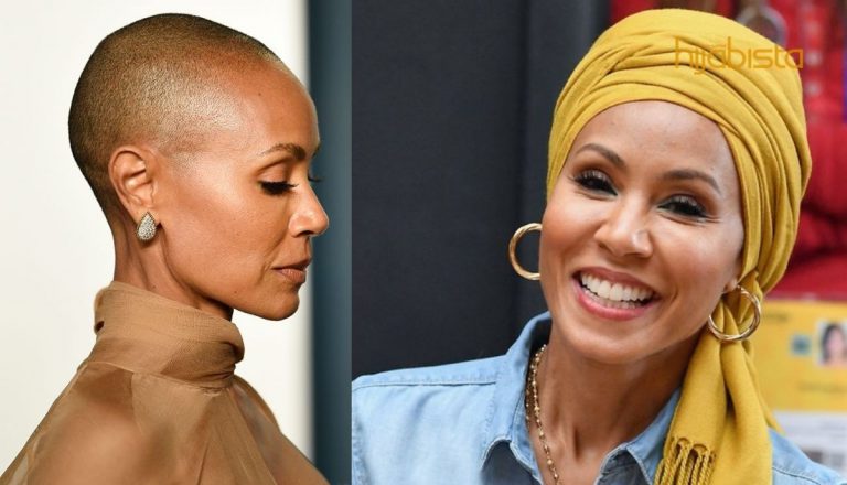 Alopecia Bukan Botak Keguguran Rambut Biasa, Malah Melibatkan Bahagian Badan Yang Berambut. Boleh Emosi!