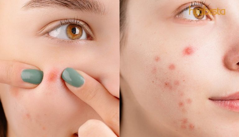 Sering Alami Wajah Berminyak, Naik Jerawat & Kulit Kusam, 5 Kunci Rahsia Ini Bantu Rawat Masalah Kulit!