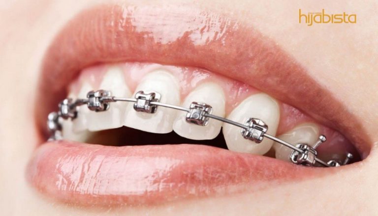 ‘Fake Braces’ Punca Penyakit Berjangkit, Pakar Kongsi Tentang Trend Pemakaian ‘Braces’