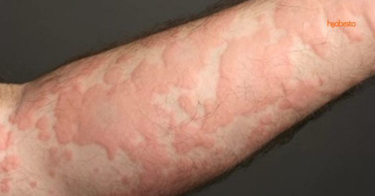 Mula Gatal-gatal Lepas Maghrib Bukan Sebab Kena ‘Ludah’ Dengan Jin, Doktor Ini Kongsi Faktanya