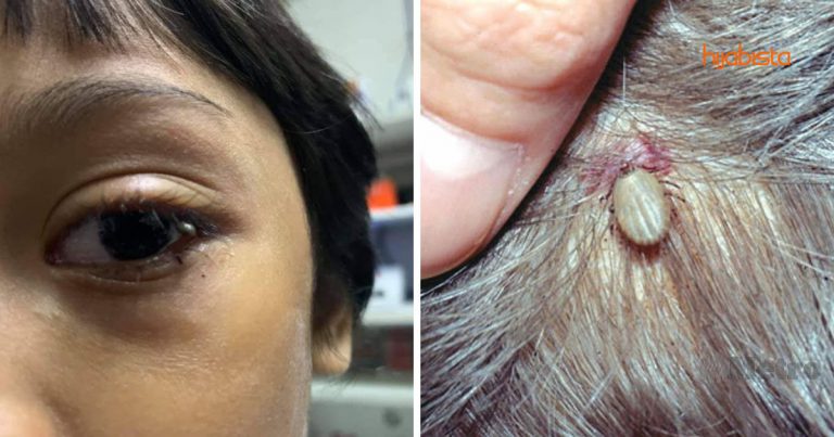 Awas Jika Terkena Sengkenit, Boleh Buat Lumpuh Muka & Bengkak Hati