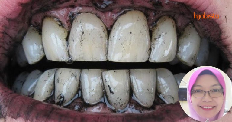 Gigi Jadi Putih Lepaskan Guna Bahan Berasaskan Arang? Namun Tidak Mengikut Doktor Ini…