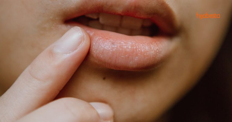 Bibir Merekah & Mengelupas Boleh Disebabkan Alahan Pada Makanan Tertentu Selain Kurang Minum Air & Cuaca
