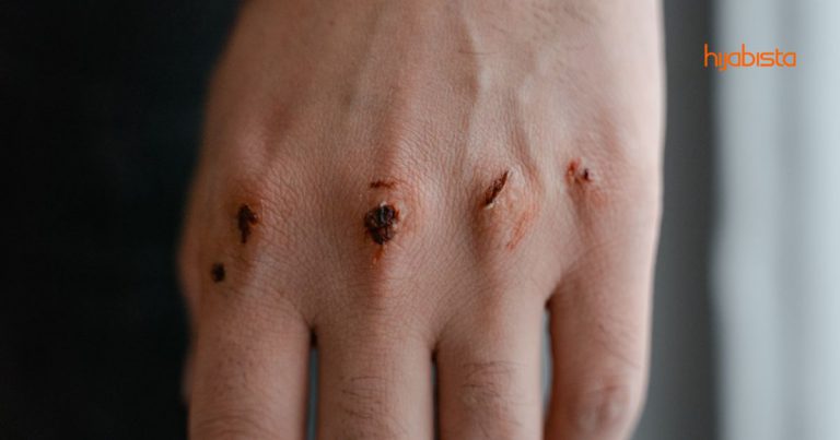 Mitos Tentang Penjagaan Luka, Betul Ke Jangan Makan Kicap, Nanti Parut Jadi Hitam