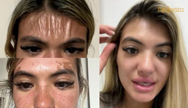 Langkau Memakai Pelindung Matahari Semasa Berjemur, Pakar Kecantikan Alami Dahi Berkedut Seperti Plastik