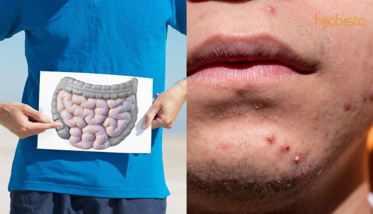 Sering Emosi Kerana Kulit Yang Berjerawat? Mulakan Dengan Penjagaan Usus Yang Betul