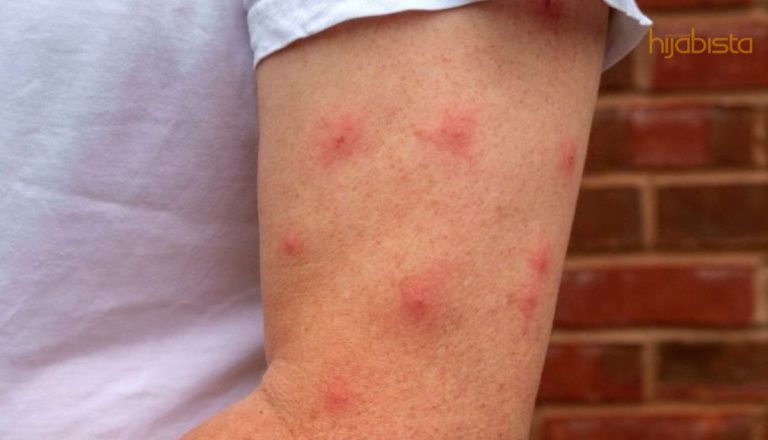 Kulit Jadi Teruk Sebab Nyamuk Gigit. Ini Tumbuhan Yang Boleh Bantu Halau Nyamuk Dekat Rumah!