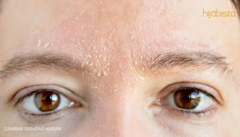 Kening Selalu Gatal Merupakan Tanda Anda Mempunyai Diabetes? Ini Adalah Puncanya..