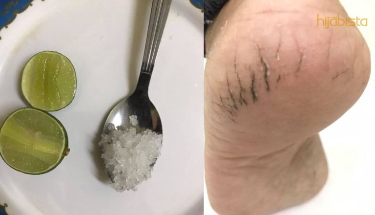 Muka Cantik Tapi Tumit Merekah Sebab Pakai Kasut Tinggi? Ini 2 Bahan Yang Anda Boleh Gunakan!