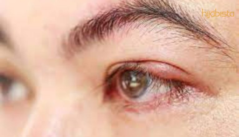 Punca Ketumbit Tumbuh Kerana Kerap Memakai Kanta Lekap? Wanita Perlu Berhati-Hati!