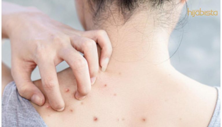 Jerawat Dekat Badan Tanda Anda Pengotor? Betul Ke? Ini 6 Cara Hilangkan Jerawat Badan!