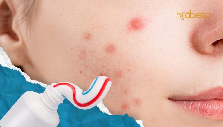 Masih Pakai Ubat Gigi Sebagai Rawatan Jerawat? Anda Hanya Tempah Lebih Banyak Miss J!