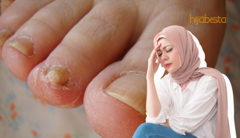 Kuku Menjadi Kuning Akibat Jangkitan Kulat! Jangan Biarkan Begitu Sahaja…