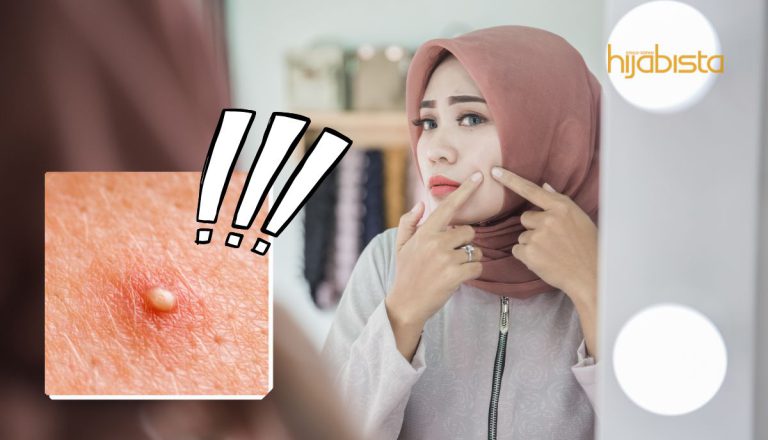Alamak! Jerawat Muncul Dekat Muka, Perlu Picit Atau Tak?