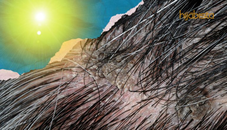 Terlalu Lama Bawah Matahari Buat Kulit Kepala Bengkak! Hati-hati Bila Beriadah…