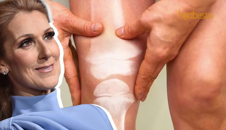 SPS Tiada Ubat Tapi Boleh Dirawat, Sindrom Ini Yang Dialami Celin Dion. Wanita Umur 30 Ke Atas Berjaga-Jaga!