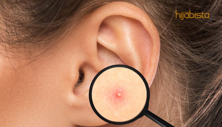 Cuping Telinga Bengkak Dan Naik Merah, Itu Mungkin Satu Ketumbuhan Dan Bukan Jerawat!