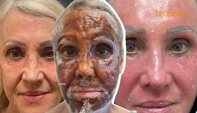 Bakar Kulit Wajah Demi Hilangkan Kedutan, Fahami Rawatan Pengelupasan Phenol. Ada Berani Ke?