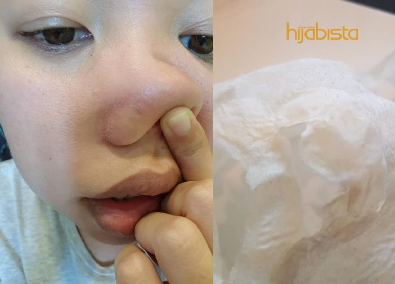 Elak Habis Puluhan Ringgit, Wanita Ini Kongsi Petua Hilangkan Whitehead & Blackhead Modal 50 Sen