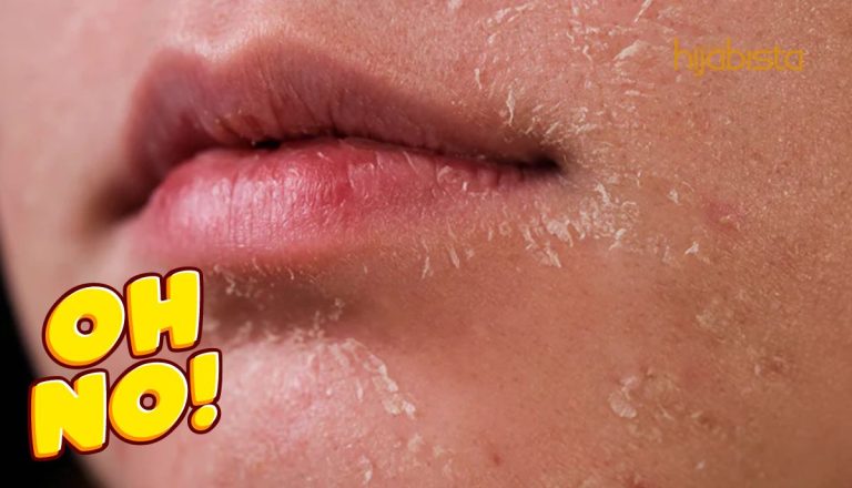 Selain Penggunaan Produk Yang Salah, Ini Punca Lain Kenapa Kulit Muka Anda Sering Mengelupas!