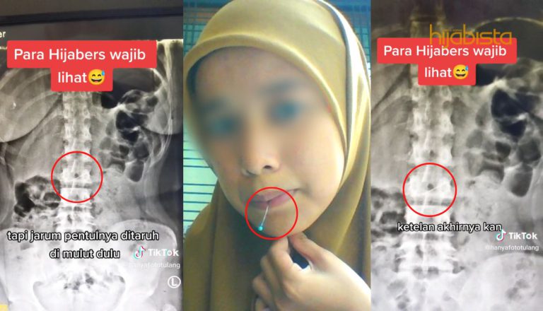 Hijabi Tertelan ‘Jarum Peniti’ Ketika Pakai Tudung! Hampir Jalani Pembedahan Jika..