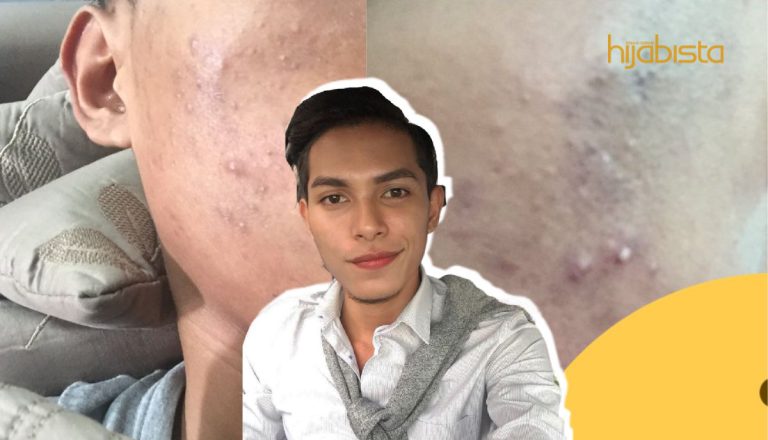 Jejaka Ini Pulih Dari Breakout Dan Miliki Wajah Baru Dengan Kos Murah! Tak Perlu Rawatan Mahal-mahal