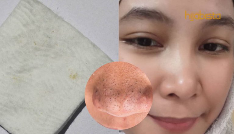 Guna Teknik ’15-5′ Dan Blackhead Anda Hilang Begitu Sahaja! Puas Hati Banyak Yang Keluar