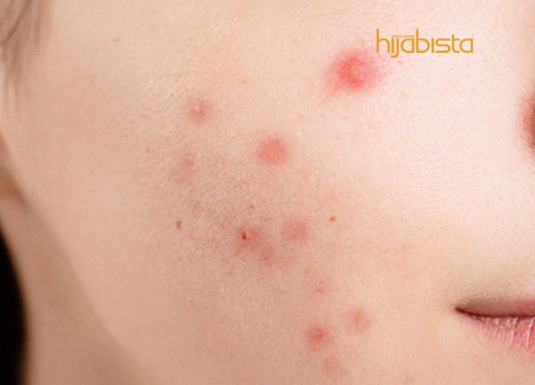 Beauty Guru Dedah Produk Terbaik Bagi Hilangkan Parut Hitam Untuk Wajah Flawless