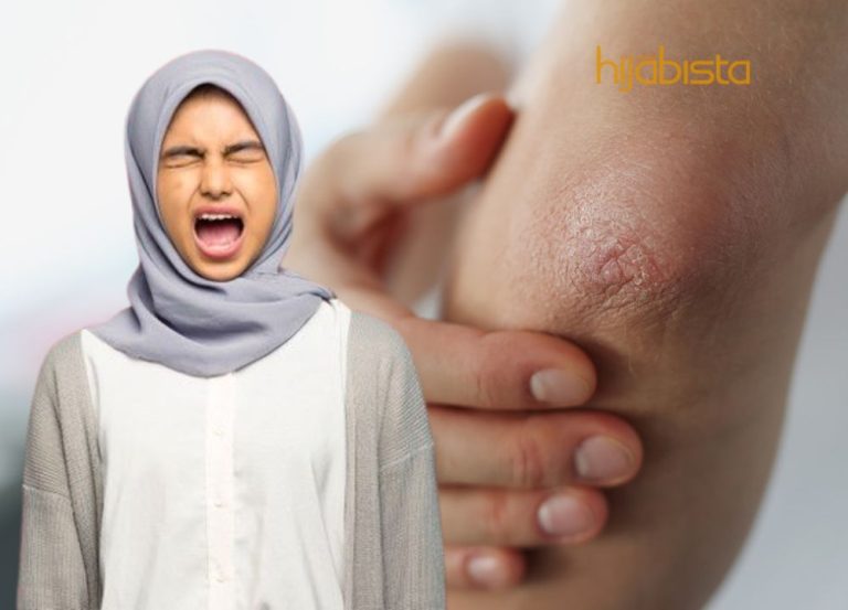 Sering Mengalami Siku Kering? Ini Cara Mengatasi Siku Yang Kering Dengan Mudah!