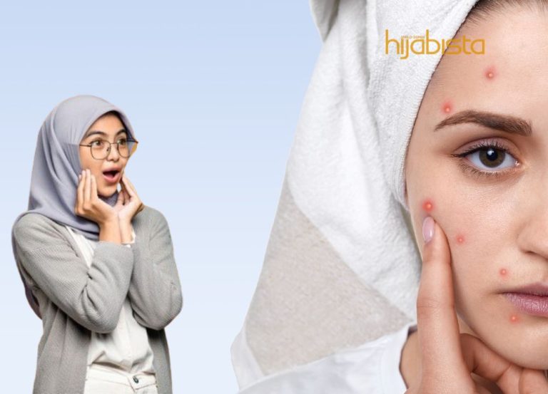 Wajib Tahu, Ini Petua Cegah Jerawat Semasa PMS!